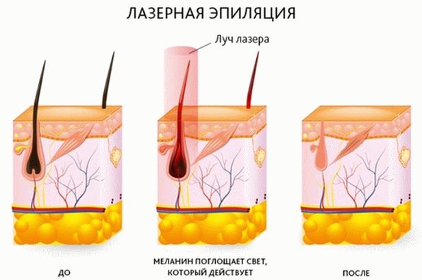 contraindicații și consecințe pentru epilarea cu laser