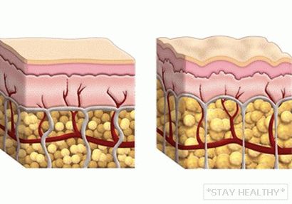 prichiny-vozniknoveniya-tsellulita