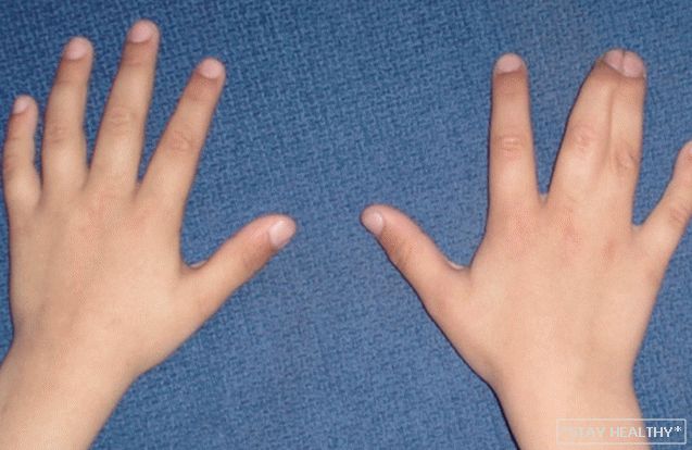 Ce înseamnă degetele accrete - sindactilădegetele și mâinile