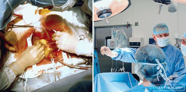 Cum este operația de îndepărtare a uterului și apostoperator