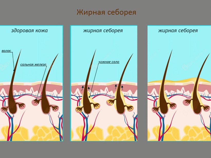 tratament gras la seboreea scalpului