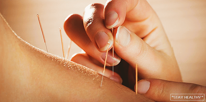 Slabire cu acupunctura