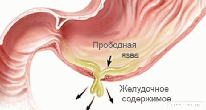 Perforat (perforativ) ulcer gastric șiulcer duodenal